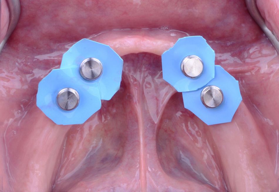 Figure 43. Intraoral direct pick up procedure. Block out rings placed over the abutments preventing excess dual cure resin processing material bellow the matrix housings.