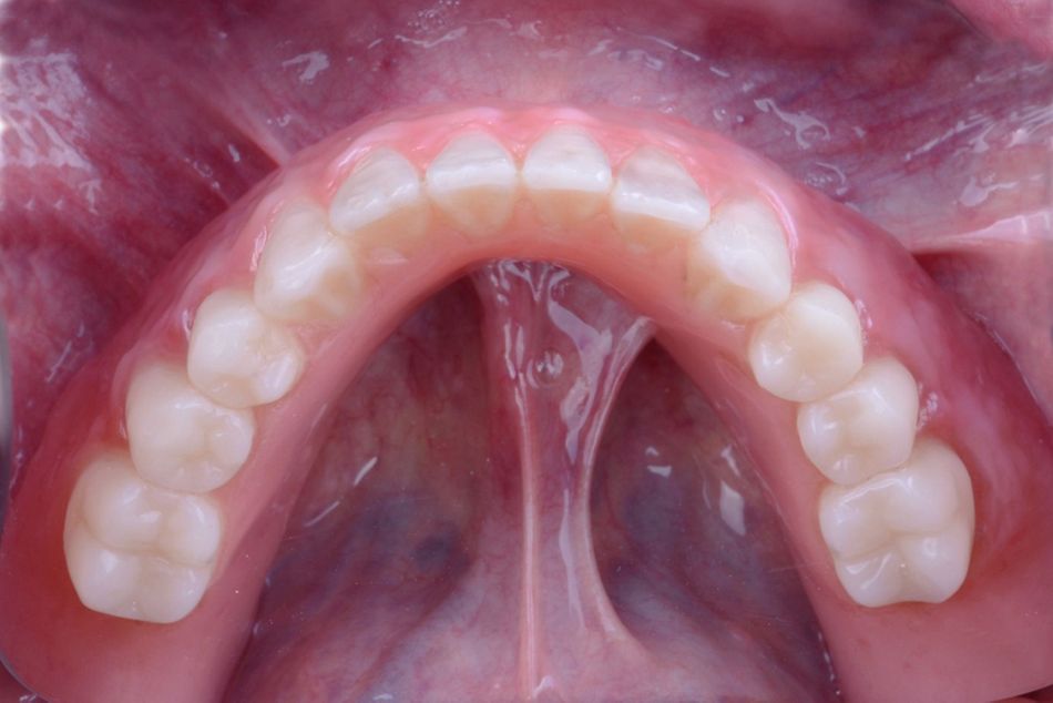 Figure 44. Intraoral direct pick up procedure. After adequate passive seating of the final prosthesis was checked, the final pick up was performed with finger pressure using dual cure self-adhesive resin material.