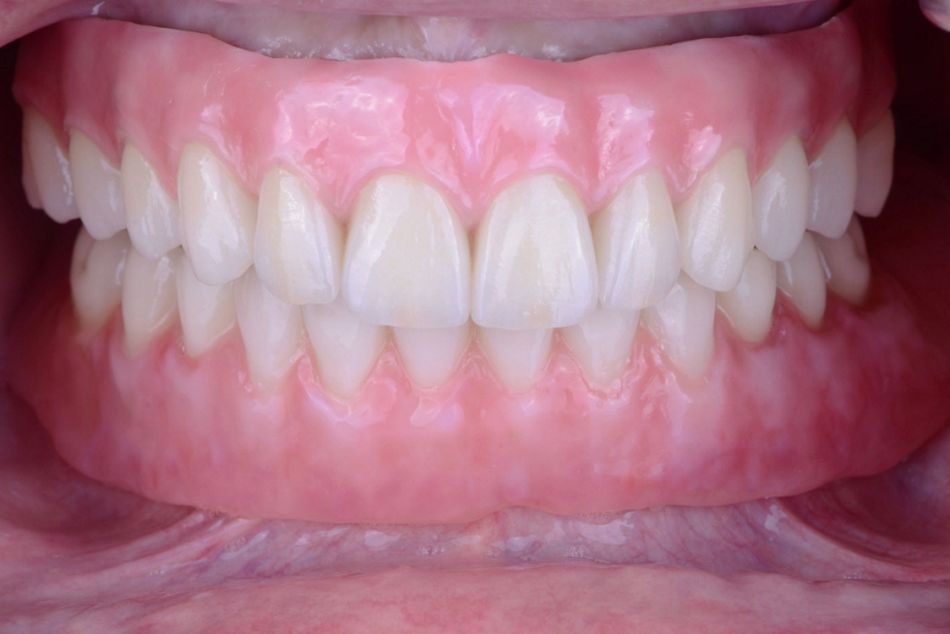 Figure 45. Final intraoral aspect of the bi-maxillary implant rehabilitation after 6 months.