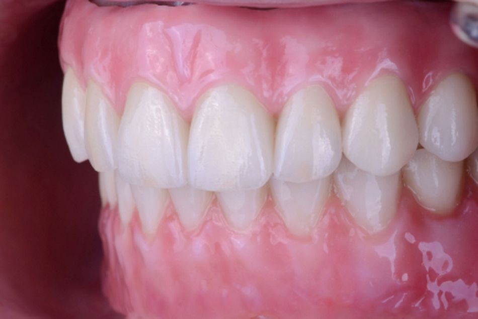 Figure 46. Final intraoral aspect of the bi-maxillary implant rehabilitation after 6 months. 