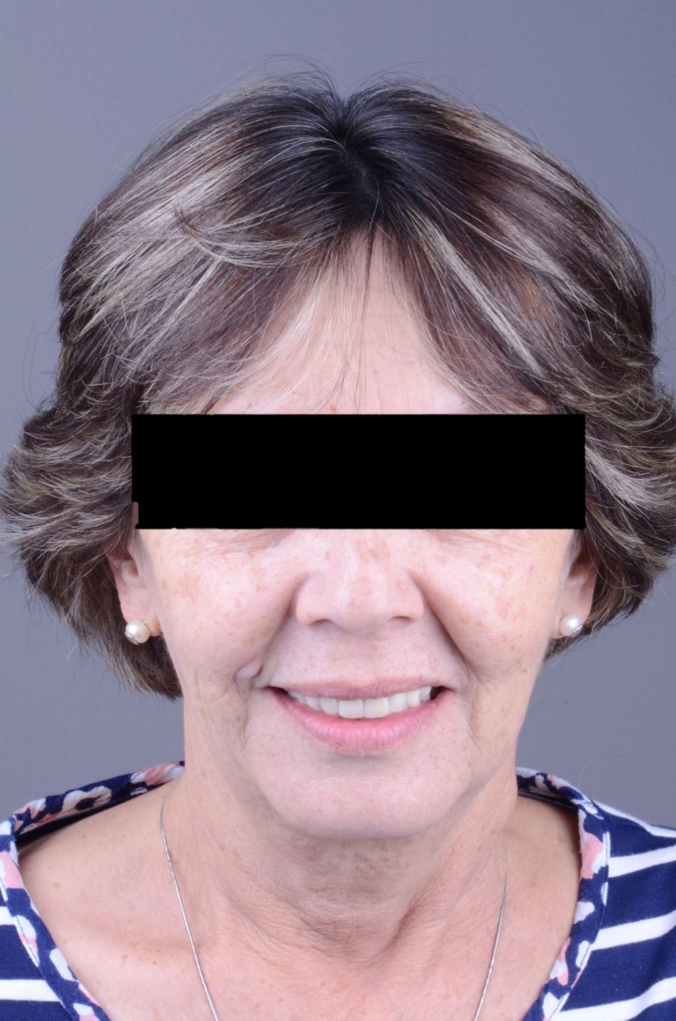 Figure 47. Final extraoral view. A very pleasant and natural smile was achieved with the implant supported prosthesis.