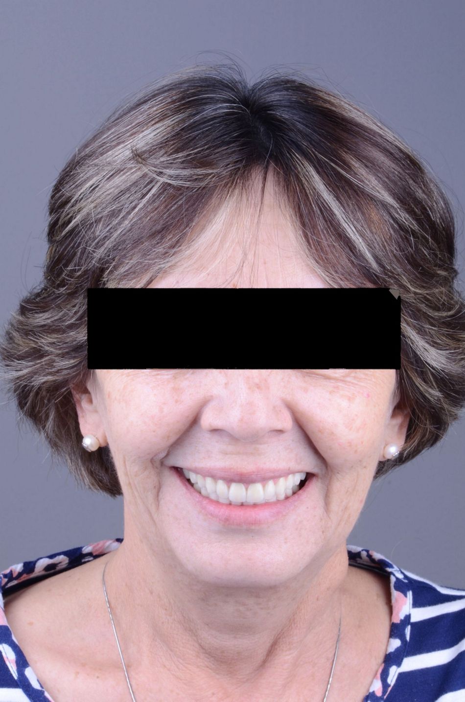 Figure 48. Final extraoral view. A very pleasant and natural smile was achieved with the implant supported prosthesis. 