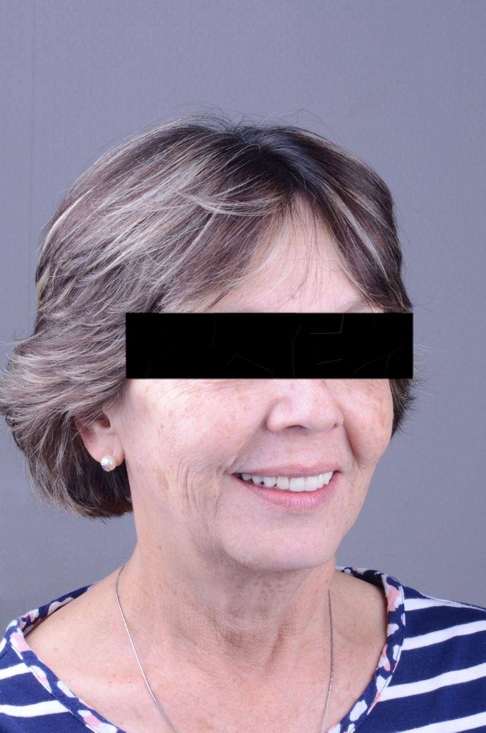 Figure 49. Final extraoral view. A very pleasant and natural smile was achieved with the implant supported prosthesis. 