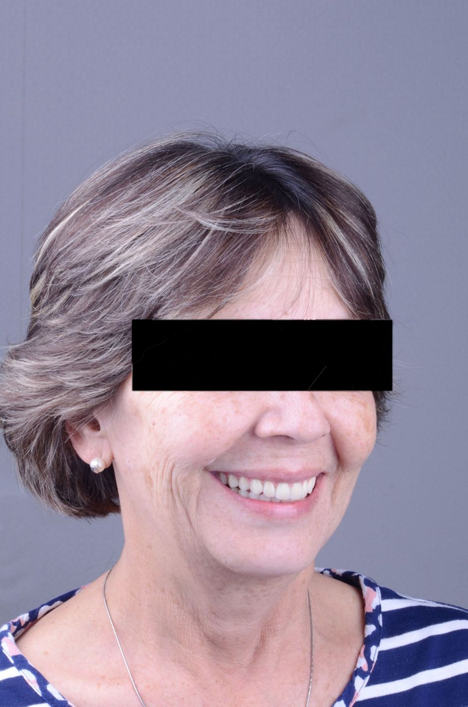 Figure 50. Final extraoral view. A very pleasant and natural smile was achieved with the implant supported prosthesis.