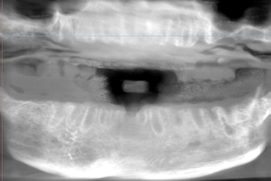 Figure 7. Baseline situation. Panoramic aspect obtained by CBCT.