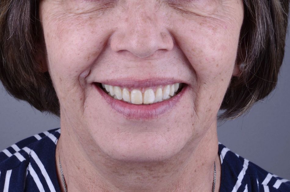 Figure 8. Transitional full dentures. Extraoral frontal view.