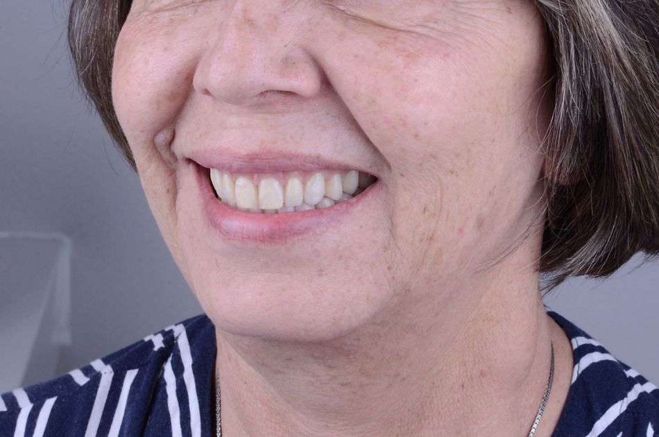 Figure 9. Transitional full dentures. Extraoral 3/4 view showing the adequate lip support provided by the buccal flange of the denture. 