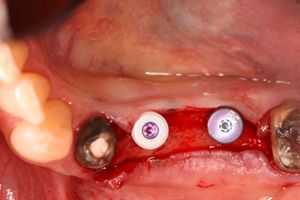 インプラントセラピー IMPLANT THERAPY 増補新版 インプラントセラピー - クインテッセンス出版