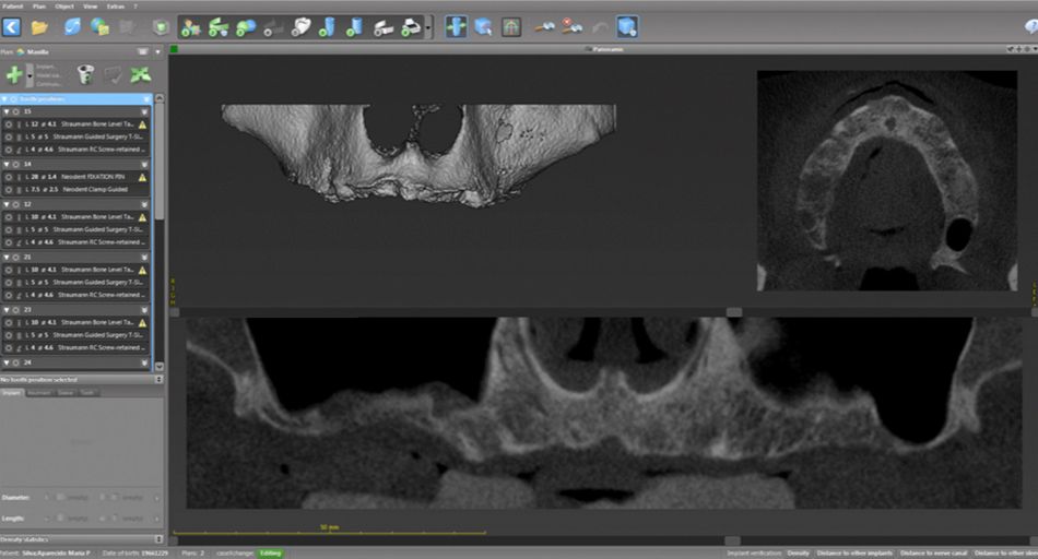 Fig 1. Initial tomography of the toothless patient.