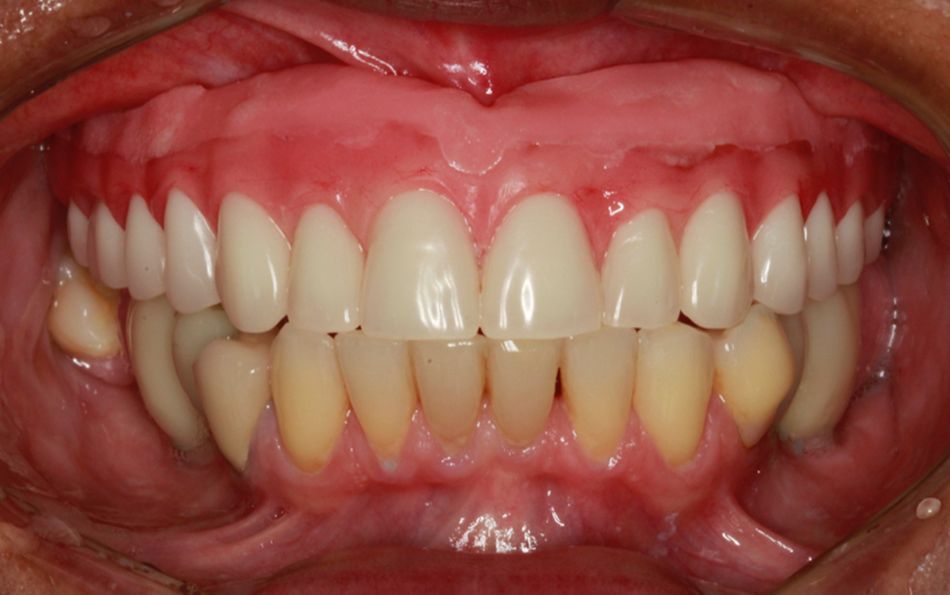 Fig 2. Initial removable prosthesis.