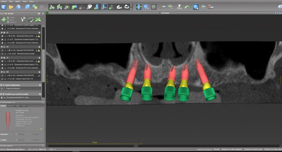 Fig 5 Figs 3-5. coDiagnostiX ™ virtual planning: the strategy was to circumvent the right and left maxillary sinus with tilted and long implants and seek apical anchoring in the lower cortex of the nasal fossa.