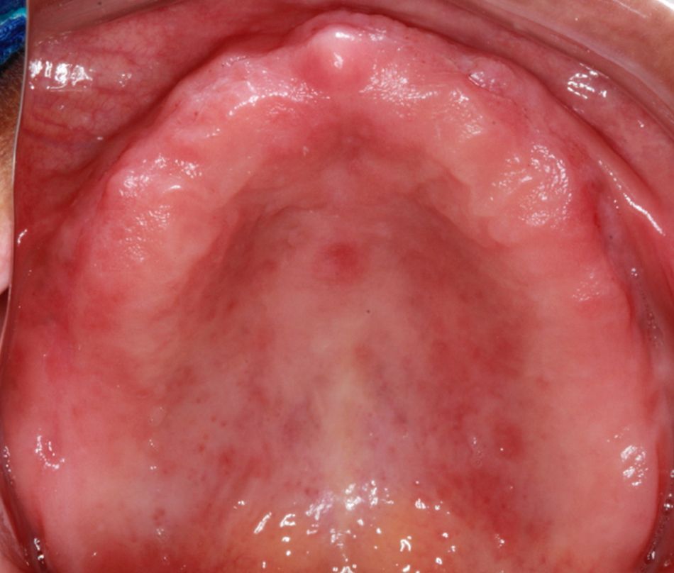 Fig 7. Toothless upper jaw initial aspect.
