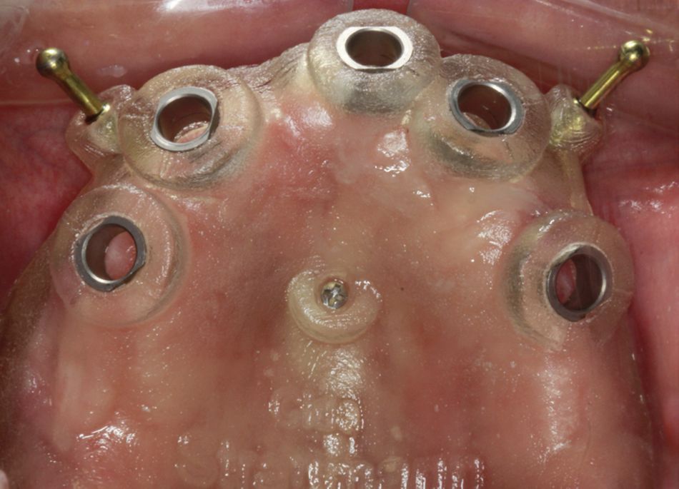 Fig 8. The drill guide was stabilized using a bone grafting screw on the palate and two fixation pins on the buccal bone.