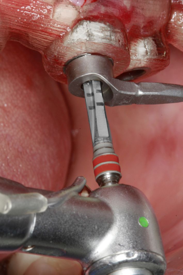 Fig 12 Figs 9-12. The sequential osteotomy preparation was completed to depth through the Straumann® BLT Guided Surgery tools.