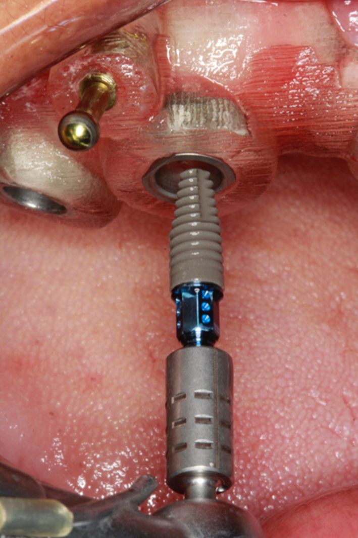 Fig 13. The Straumann® BLT fully guided implant placement.