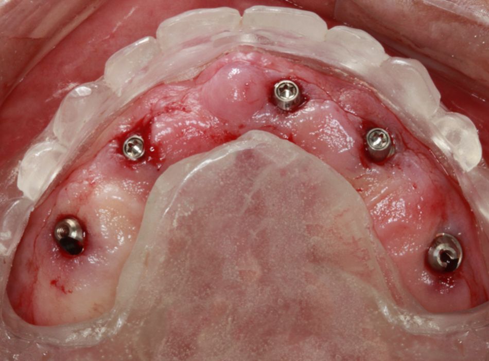 Fig 14. The multifunctional guide was placed in position to check the correct position of the implants and abutments.