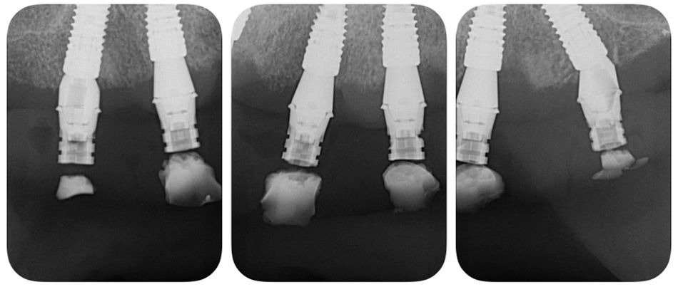 Fig 17 Figs 15-17. The patient received the fixed prosthesis on the same day of the surgery. Temporary titanium cylinders were used to capture the patient's prosthesis using the Straumann® Pro Arch technique.