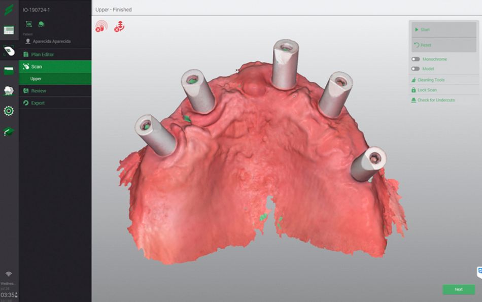 Fig 19  Figs 18-19. Intraoral scanning was performed using the Straumann® Virtuo Vivo™.