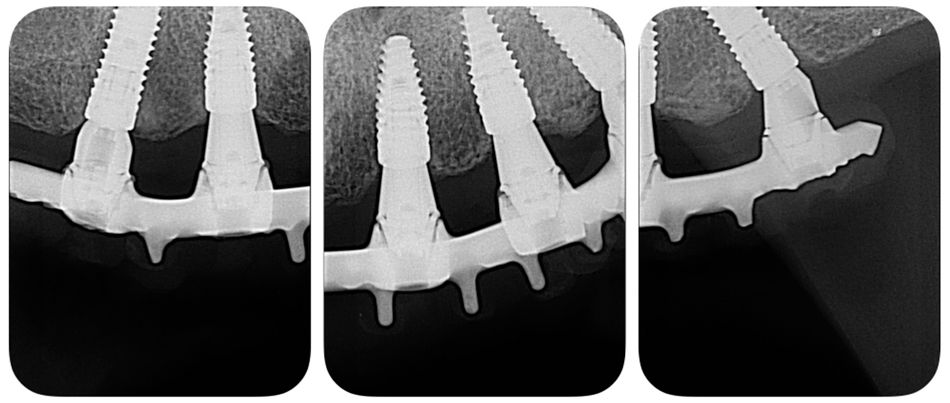 Fig 22 Figs 20-22. The metal bar was designed using the CAD/CAM Straumann® CARES system and was placed in the mouth to check the adaptation.