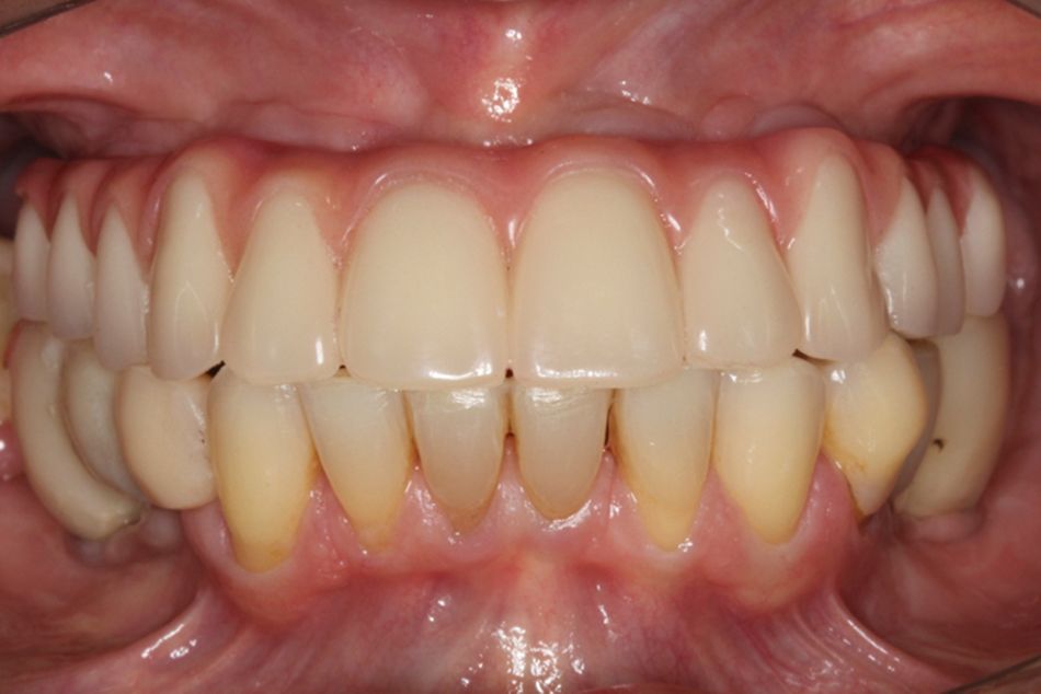 Fig 24 Figs 23-24. The prosthesis was completed following the laboratory steps. The occlusal screws were torqued to 15Ncm and the occlusion was adjusted.