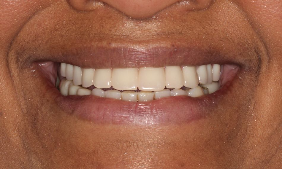 Fig 28 Figs 25-28. Two years after surgery, clinical and radiographic control was performed.