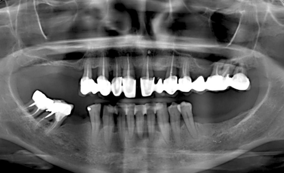Fig 2: Pre op X-rays