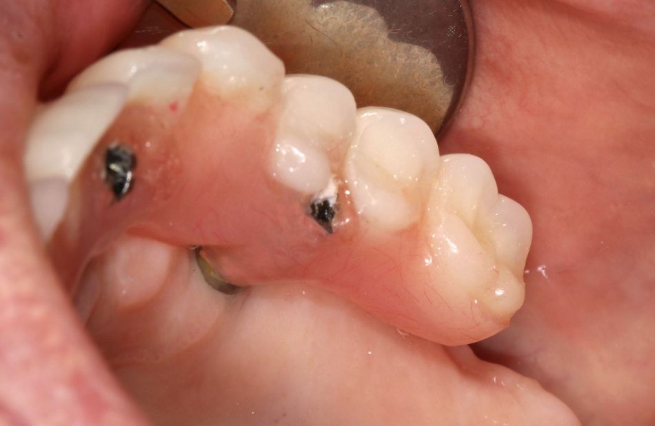 Fig 3 & 4: Cantilever length, 1.5 teeth on right side and 2 teeth on left side.
