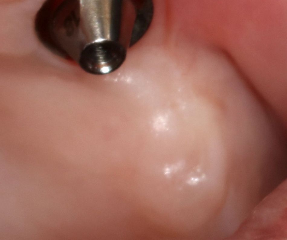 Fig 5: Soft tissues healing at posterior palate
