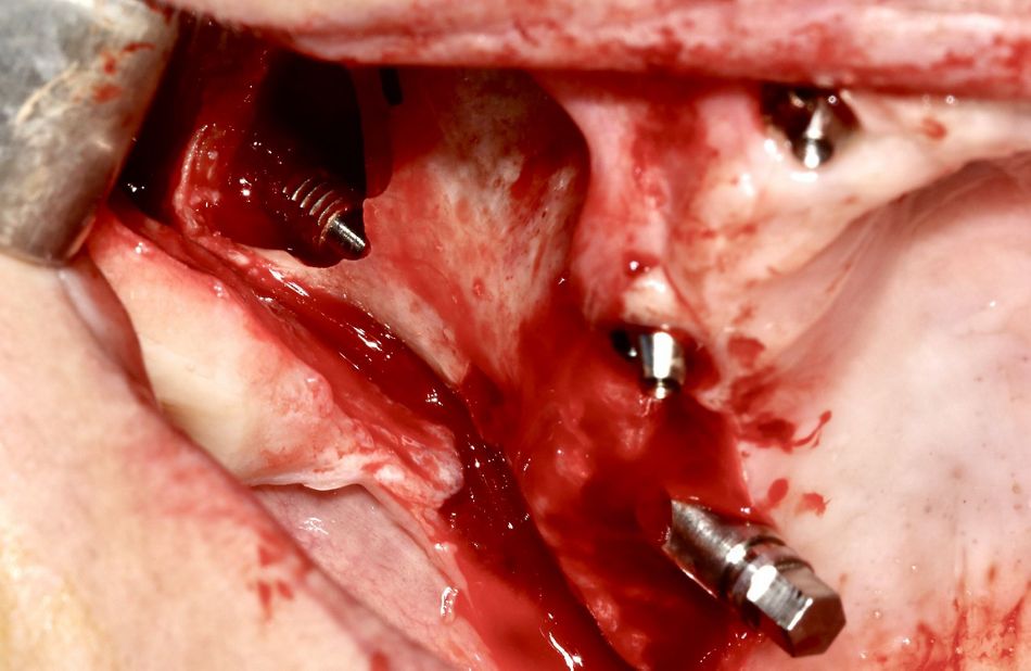 Fig 7: ZT implant insertion