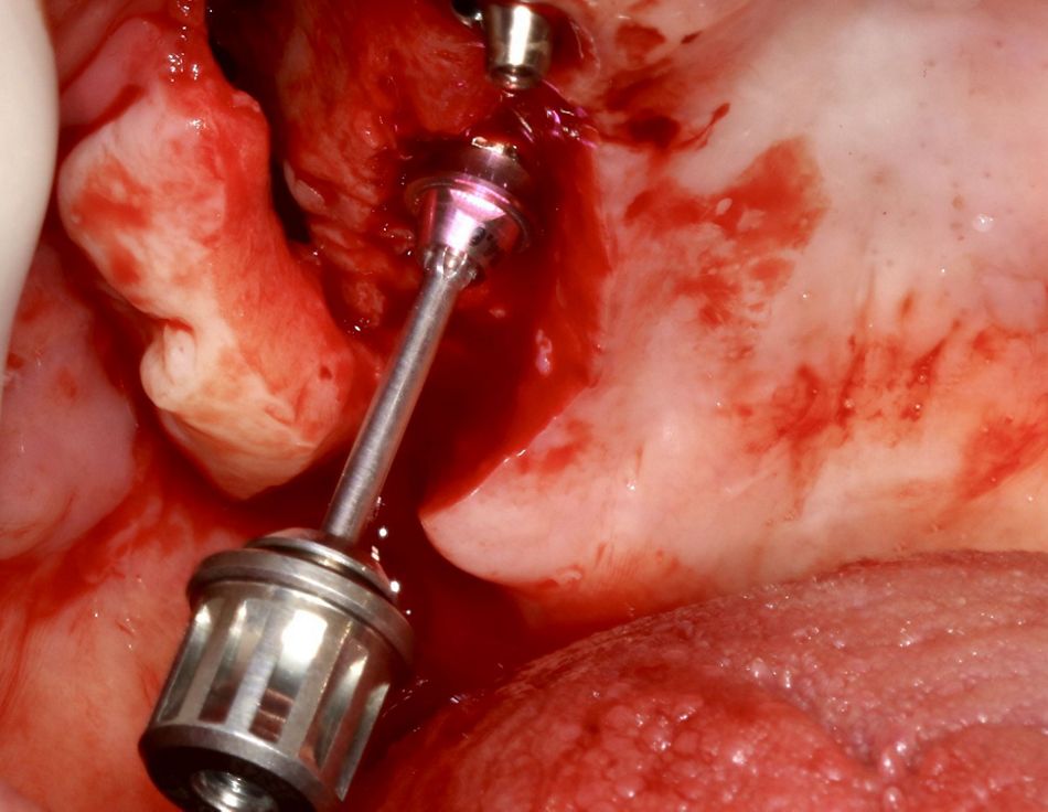 Fig 8: Placement of the screw retained abutment