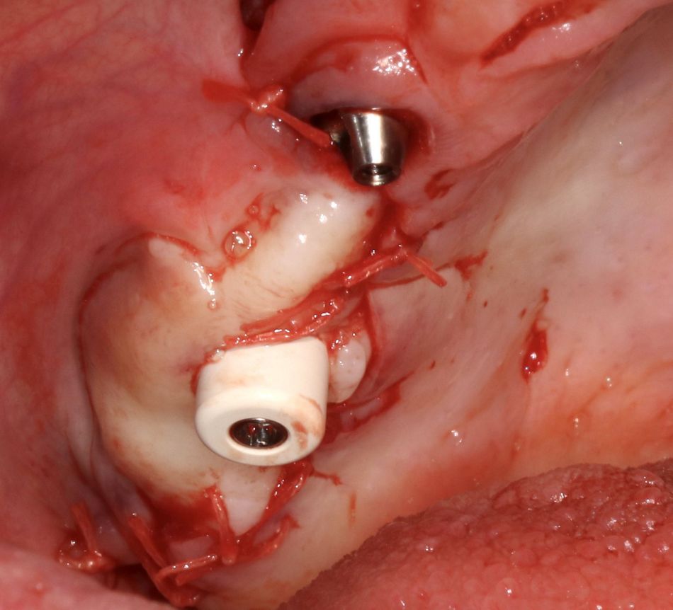 Fig 9: Keratinized gingiva surrounding the abutment