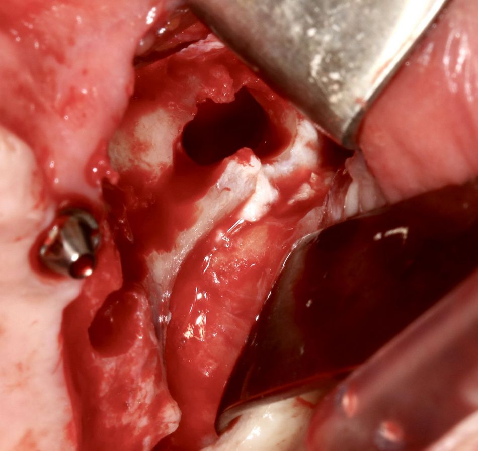 Fig 10: ZAGA 3 situation with a very thin bony crest