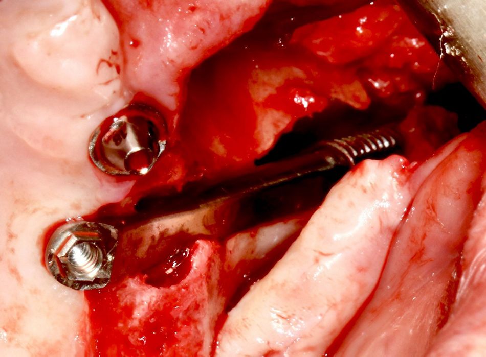 Fig 11: Choice of a long ZC implant to place the abutment adequately on the palatal bone