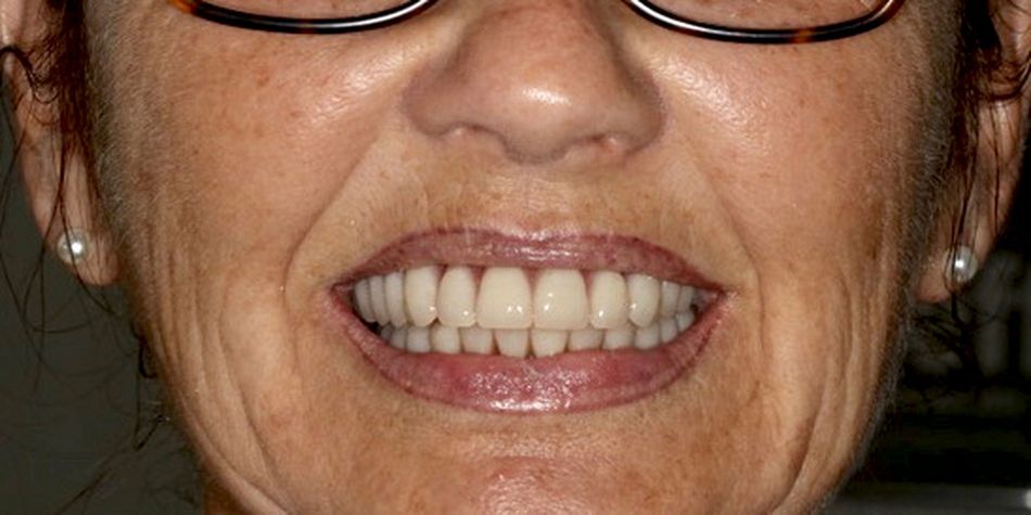 Fig 12 Final outcome, showing restored aesthetic and function.