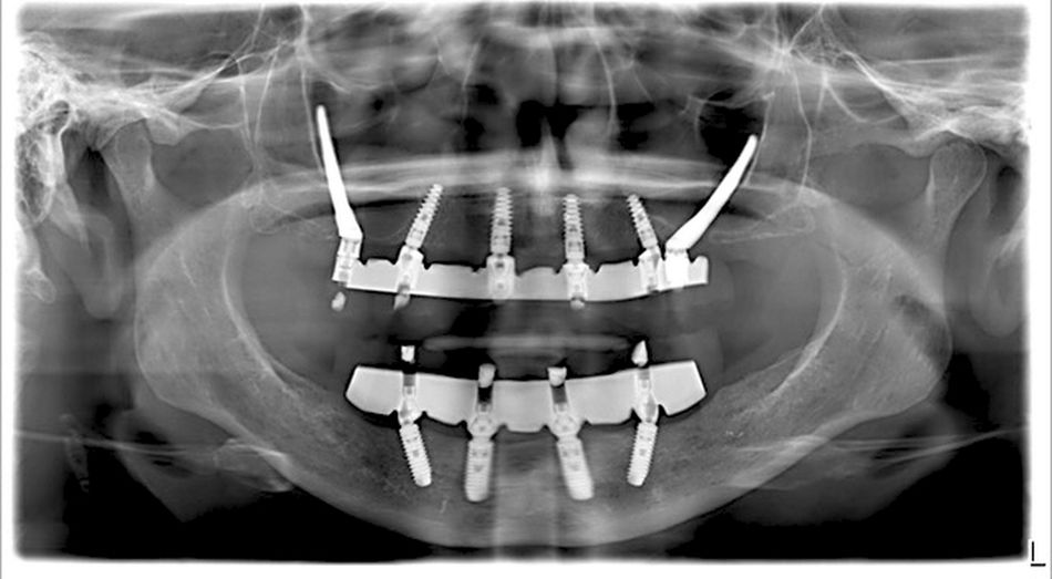 Fig 13: Final OPG