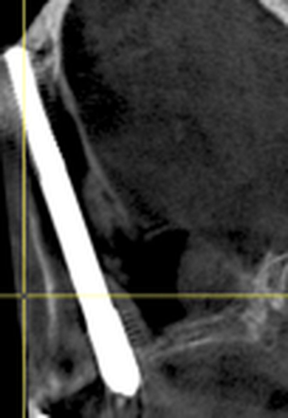 Fig 14 & 15: CBCT, please notice the difference between ZAGA 0 (right side of patient) with intra-sinus path (Fig. 14) and ZAGA 3-4 (left side of patient), extra sinus (Fig. 15).