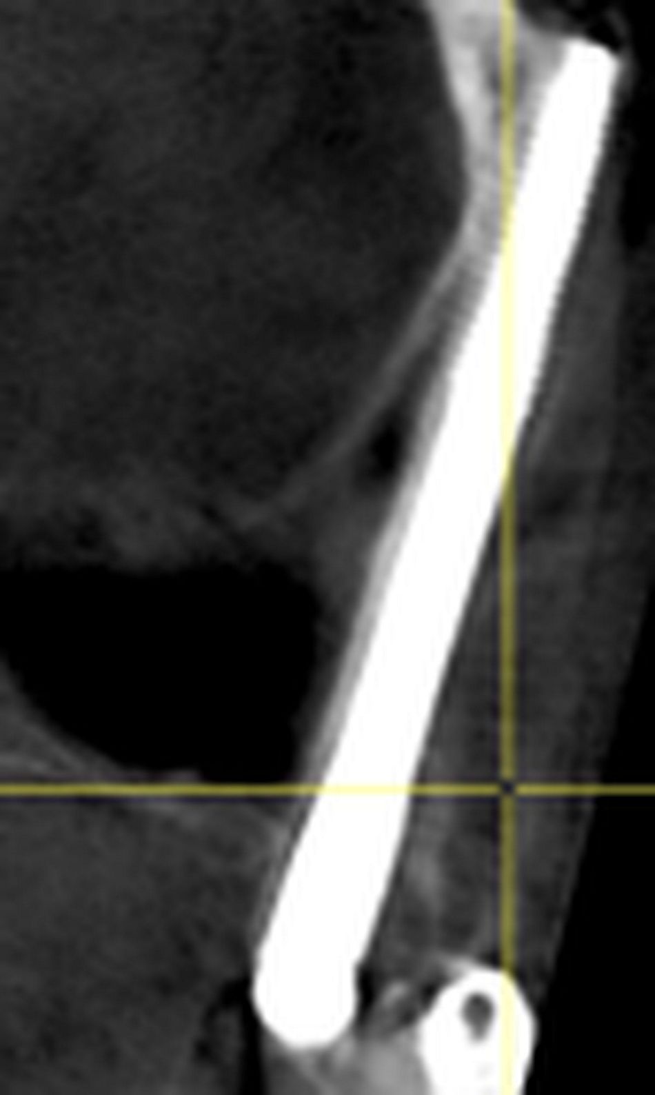 Fig 14 & 15: CBCT, please notice the difference between ZAGA 0 (right side of patient) with intra-sinus path (Fig. 14) and ZAGA 3-4 (left side of patient), extra sinus (Fig. 15).
