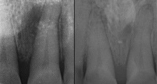 Fig. 10: Pre-op situation and 3 years follow-up