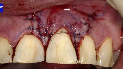 Fig. 5: Suturing