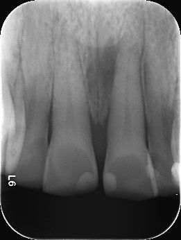 Fig. 6: 6 months post-op