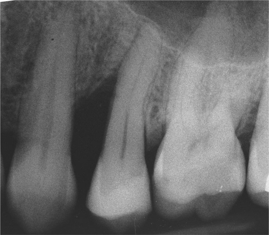 Fig. 2: Pre-op RX