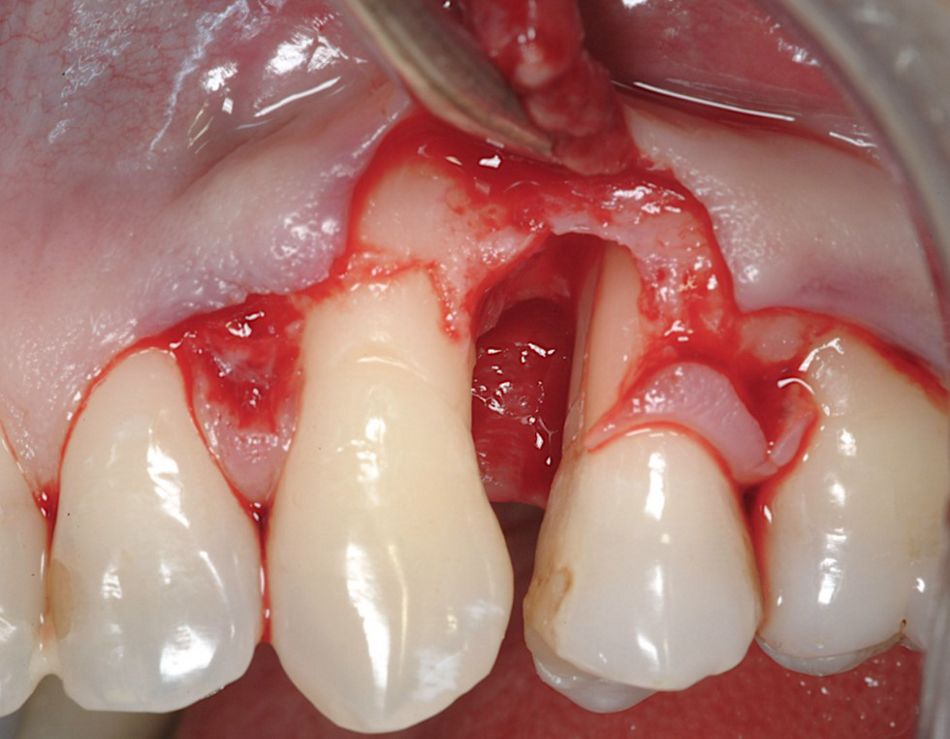 Fig. 3: The bone defect is exposed and scaling and root planing is performed