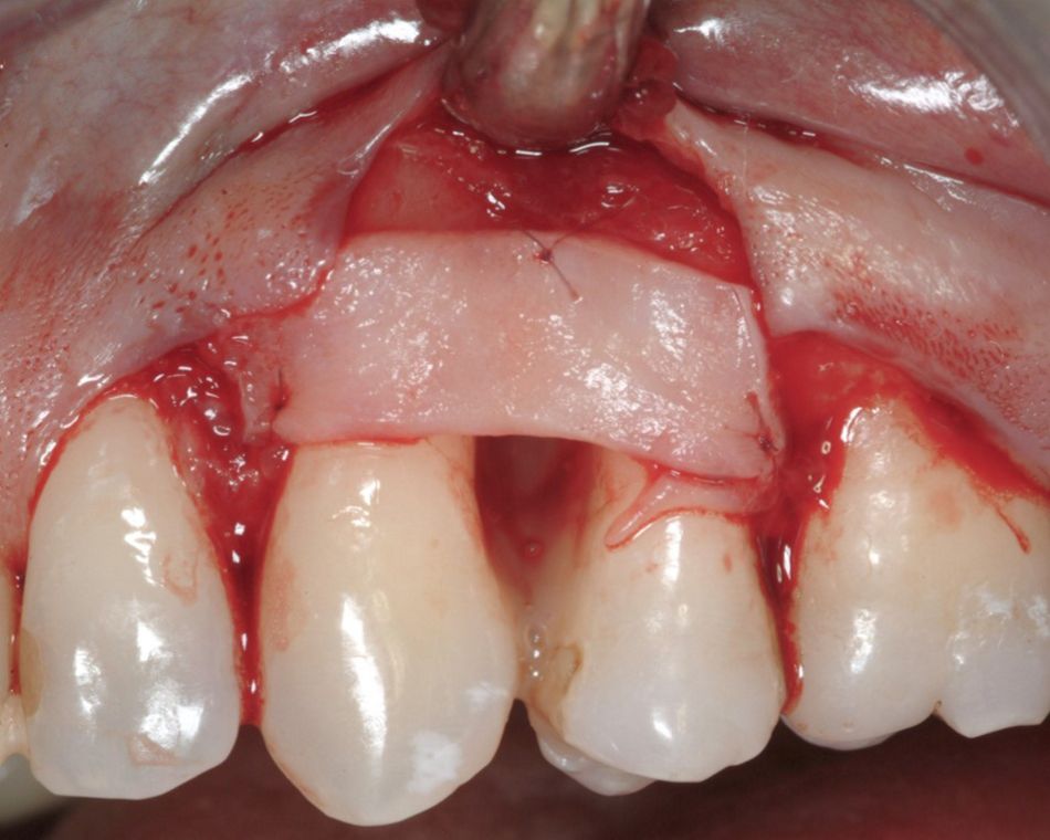 Fig. 4: Autologous connective tissue graft is applied and sutured over the defect