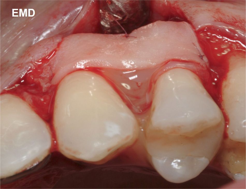 Fig. 5 Straumann® Emdogain® is applied over the defect area, in contact with the root surface