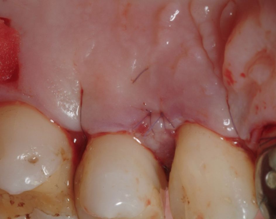 Fig. 6: Suturing