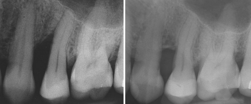 Fig. 9: Before and 5 years follow-up RX