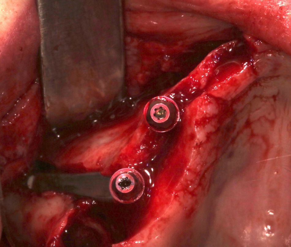 Fig. 14: Straumann® Zygomatic Implant ZAGA™ Flat submerged as far as possible into bone crest. 