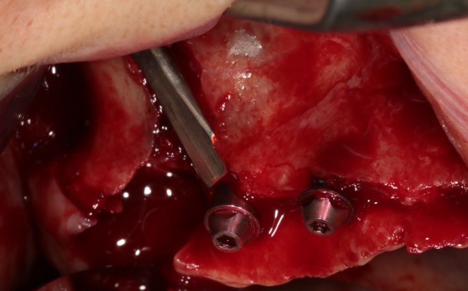 Fig. 15: The fl attened middle part does not compress soft-tissue vascularity.