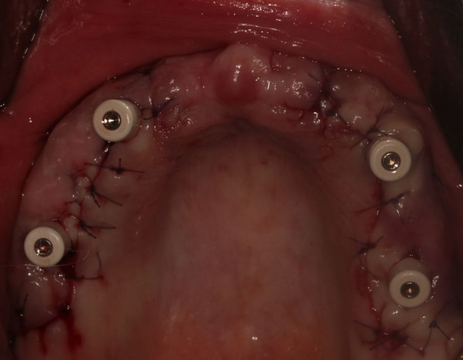 Fig. 17: Healing caps on the screw-retained abutments and crestal emergence on the prosthetic arch.