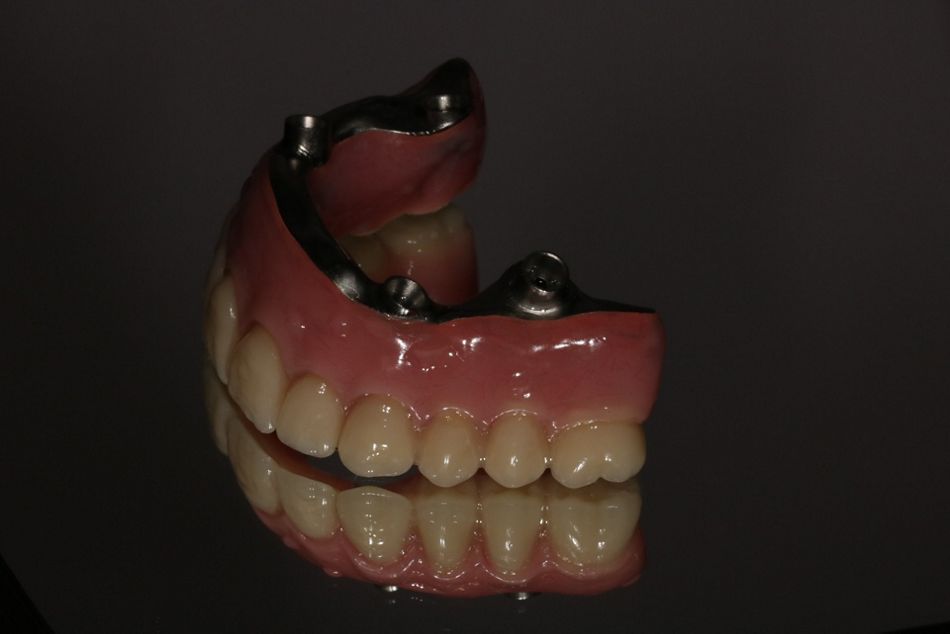 Fig. 20: CAD/CAM high-precision milled titanium bar (Createch Medical).